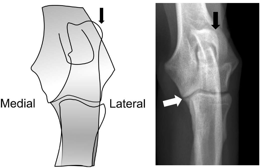 Roentgen Figur 2 - Optimal gestreckter Ellenbogen